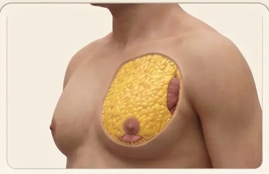 Anatomical illustration of a fat-predominant male chest with a thick yellow fat layer
