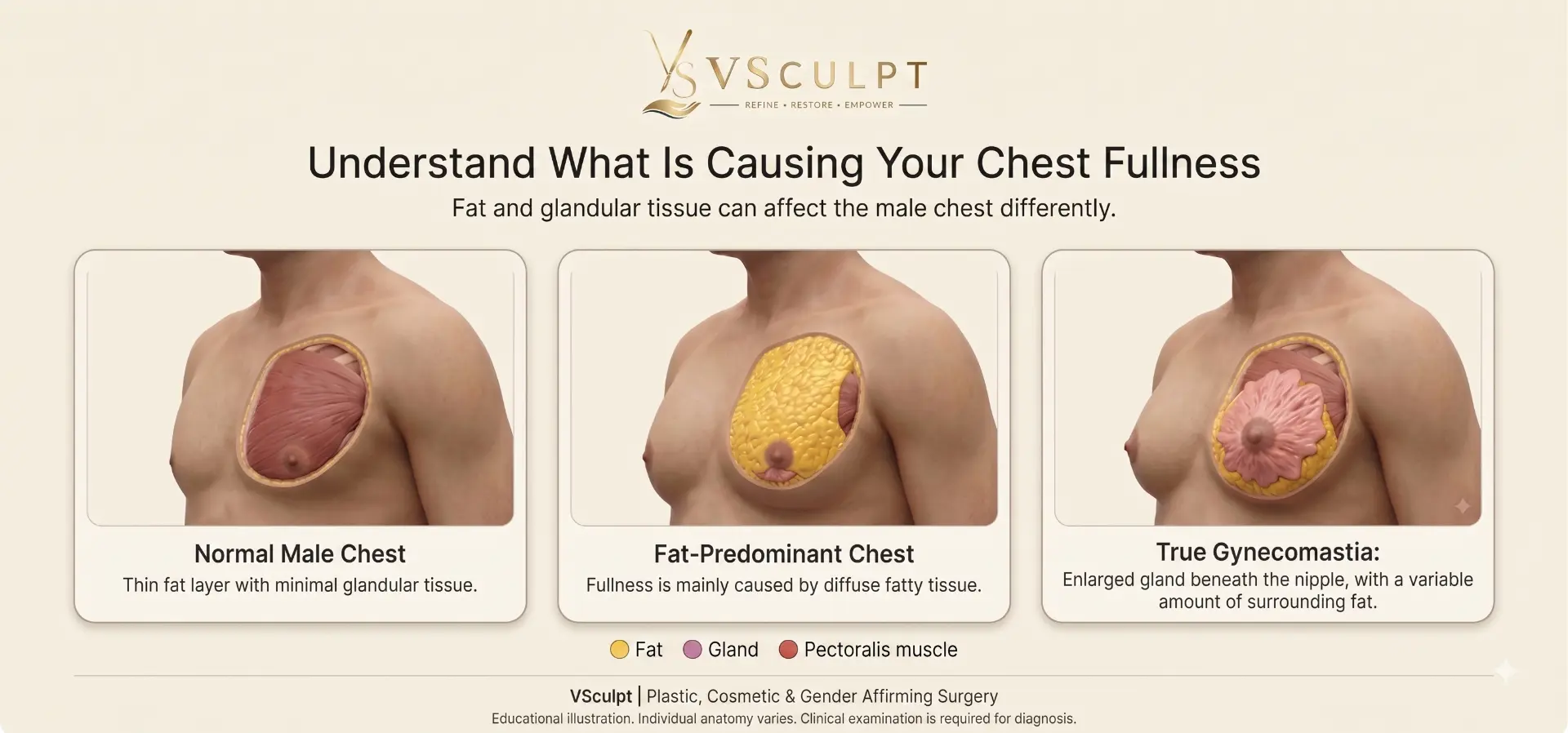 Educational illustration comparing a normal male chest, a fat-predominant chest and true gynecomastia