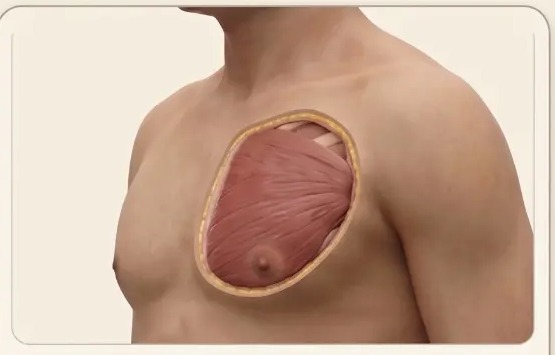 Anatomical illustration of a normal male chest showing pectoralis muscle under a thin fat layer