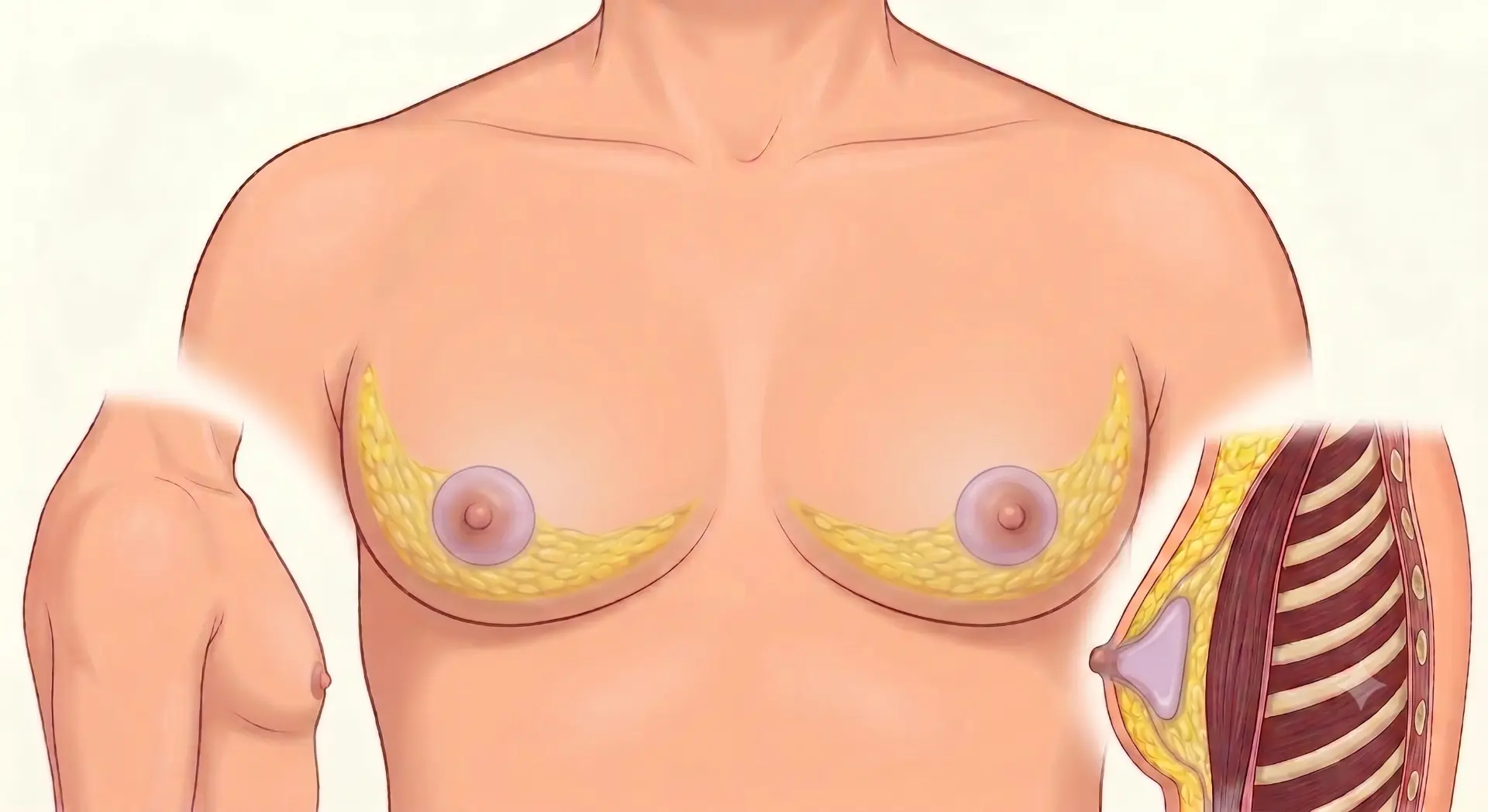 Grade I gynecomastia — educational anatomy illustration of the male chest